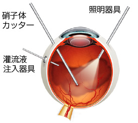 硝子体手術